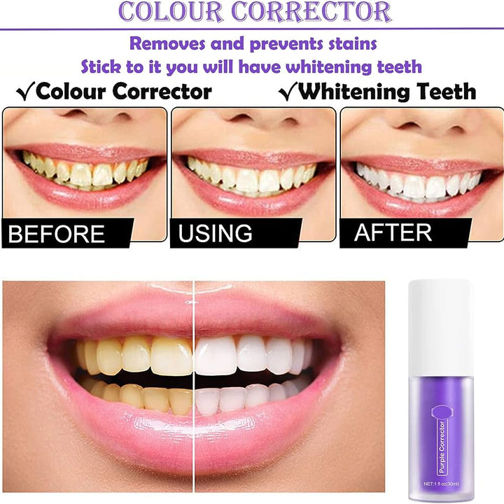 Smilekit - White Teeth Corrector